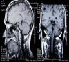 سن مغز می‌تواند مرگ را پیش‌بینی کند