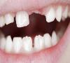 بی دندانی عامل چاقی و کاهش طول عمر افراد