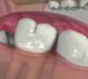 کشیدن دندان عقل مفید یا مضر؟