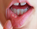 
آفت دهانی یک بیماری دردناک و عود کننده مخاط دهان بوده که به صورت زخم‌های کوچک و بزرگ، گرد و کم عمق هستند که در داخل دهان شکل می‌گیرند.