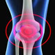 یکی از شایع ترین علت های درد زانو استئوآرتریت است. استئو به معنی استخوان و آرتریت نیز به معنی تخریب و التهاب مفصل است.