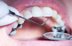 بسیاری از افراد قبل از مراجعه به دندان پزشکی برای تسکین درد دندان خود دارو مصرف می کنند. برخی از این بیماران که شکایت اصلی شان «درد» دندان است، علاوه بر ضددردها، آنتی بیوتیک هم مصرف می کنند...