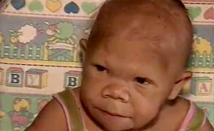 یك زن ۳۰ ساله برزیلی كه از یك بیماری نادر رنج می برد، به شكل یك نوزاد دیده می شود.