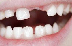 بر اساس تازه ترین بررسی های انجام شده، بیش از نیمی از علل فقدان دندان ، ریشه در وراثت و زمینه های ژنتیکی دارد.