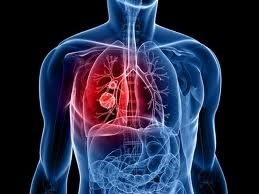 به نظر می‌رسد که دارویی که از پنهان شدن تومورها از سیستم ایمنی جلوگیری می‌کند، به طور قابل توجهی درصد زنده ماندن افراد مبتلا به یکی از انواع سرطان ریه را افزایش می‌دهد.