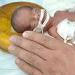 نوزاد قزوینی با قلبی خارج از قفسه سینه متولد شد.