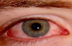 چشم‌ها وقتی قرمز می‌شوند که رگ‌های خونی ریز در سطح آن‌ها، گشاد و پر از خون شود. این اتفاق در اثر نرسیدن اکسیژن کافی به قرنیه چشم و بافت‌هایی که چشم‌ها را می‌پوشانند، می‌افتد. معمولاً قرمز شدن چشم‌ها خطرناک نیست و جای نگرانی هم ندارد، اما اگر دردناک ش