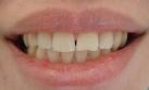 علاوه بر مسواک زدن و استفاده از نخ دندان و رعایت بهداشت دهان و دندان، ‌استفاده از مواد حاوی فلوراید مؤثرترین راه پیشگیری از ایجاد پوسیدگی های دندانی است.